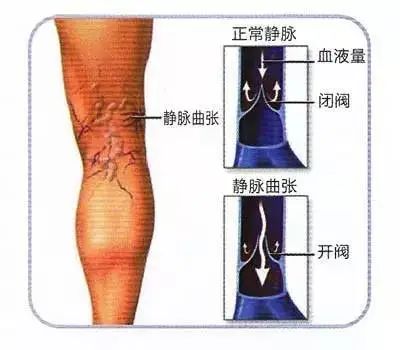 蚯蚓腿30