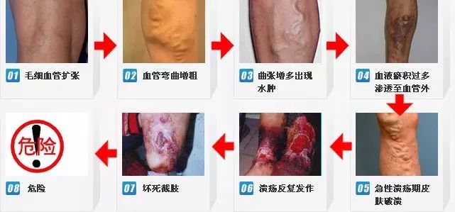 血管扩展