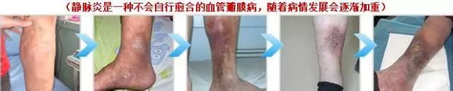 静脉炎