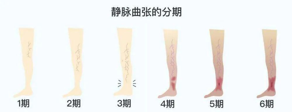 静脉曲张分级