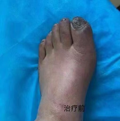 糖尿病足