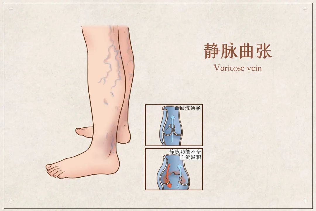 EVLT技术治疗蚯蚓腿获得患者一致好评！
