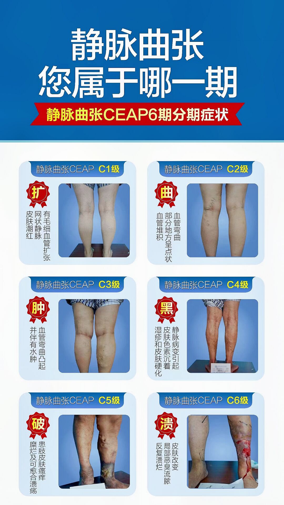 静脉曲张的临床分级0-6级讲解
