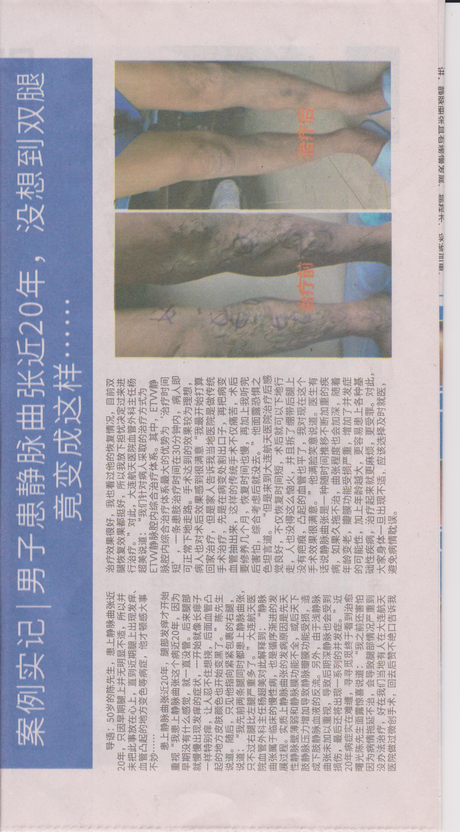 案例实记男子患静脉曲张近20年