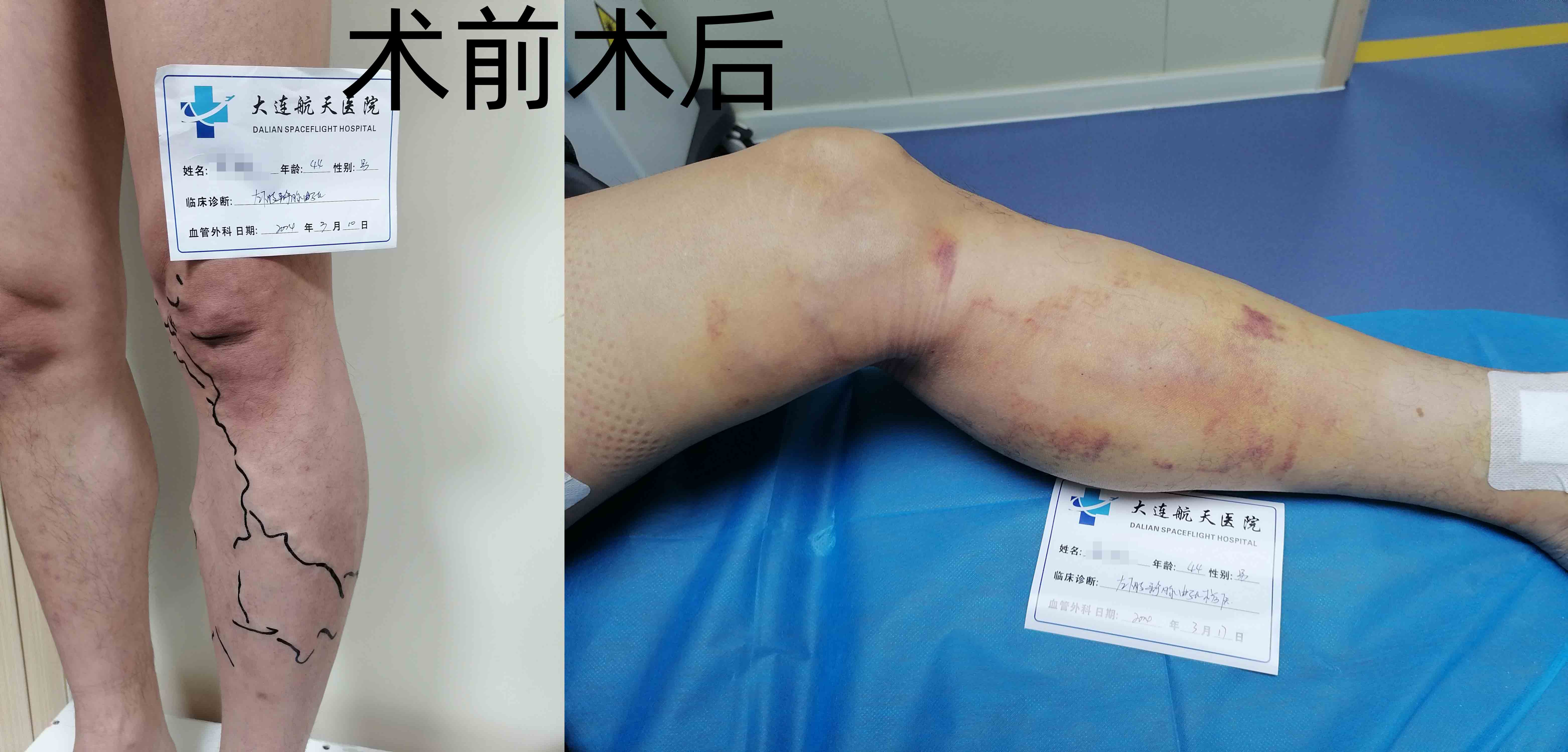 康复案例 | 左腿静脉曲张术后7天效果！