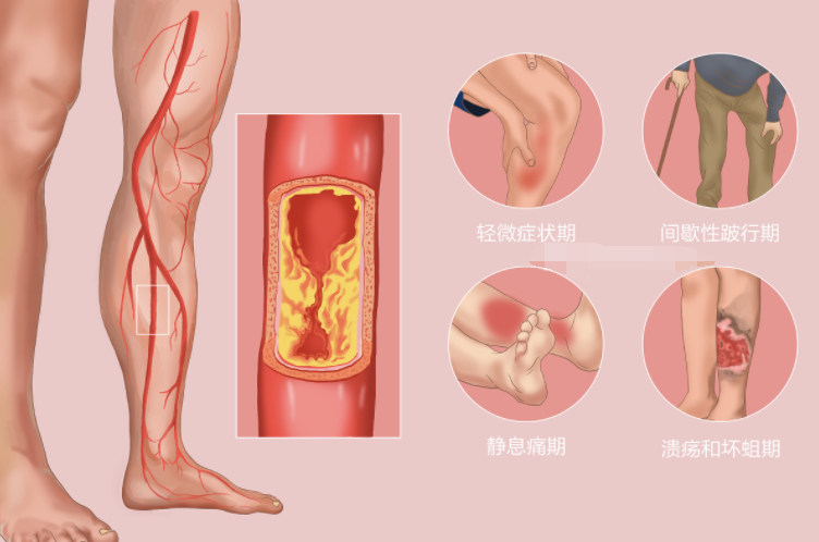 下肢动脉硬化闭塞症怎么治