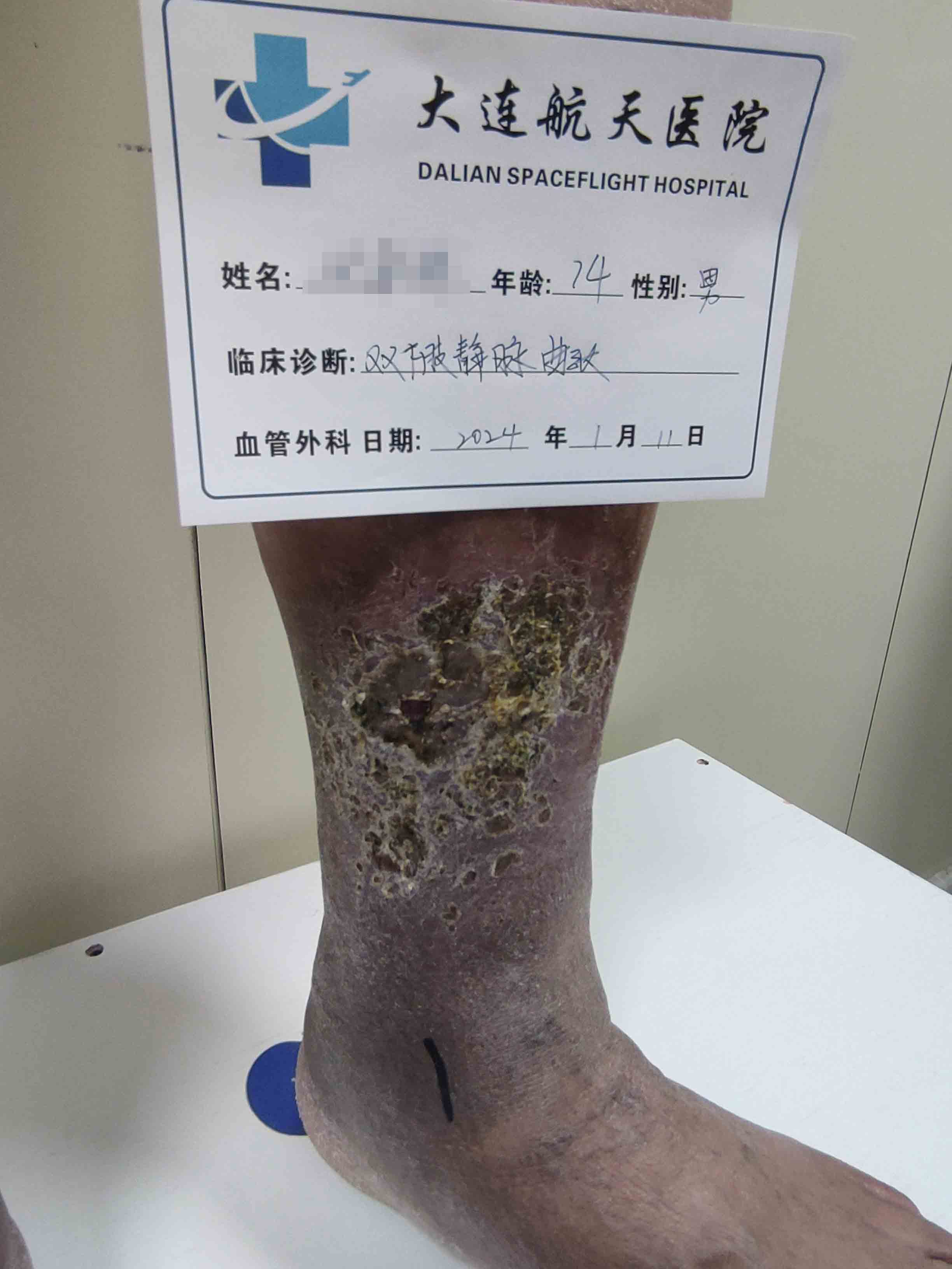 治疗老烂腿一定要手术吗？