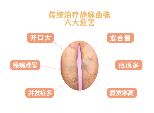毛细血管扩张就是静脉曲张吗？