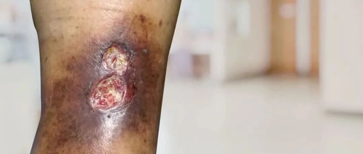老烂腿为什么老是治不好