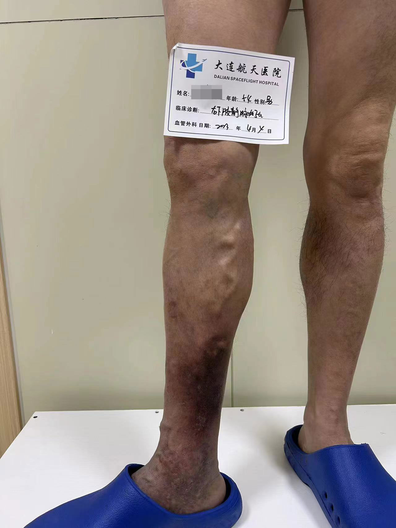 怎么治疗“老烂腿"？