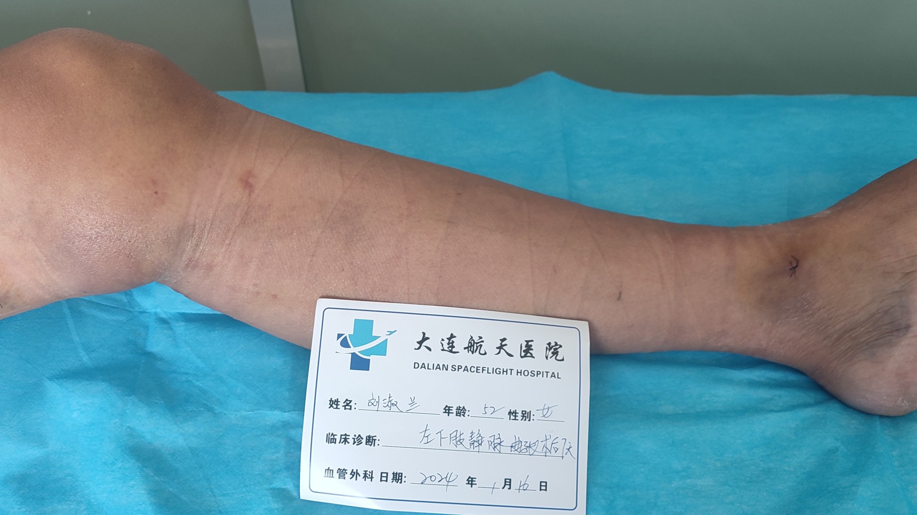 腿部静脉炎怎么治疗？