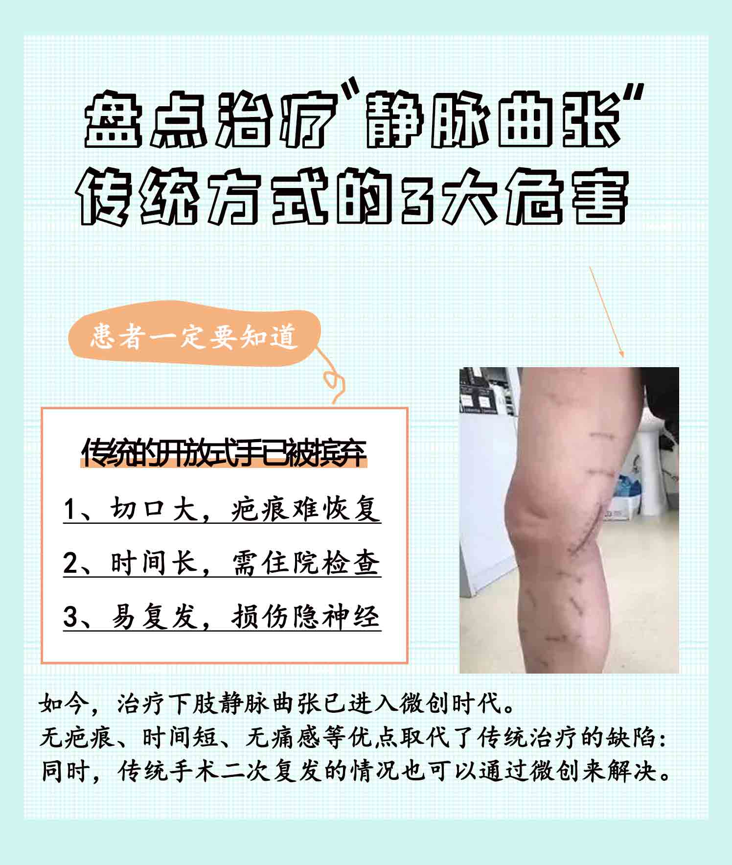下肢静脉曲张最好的治疗方式