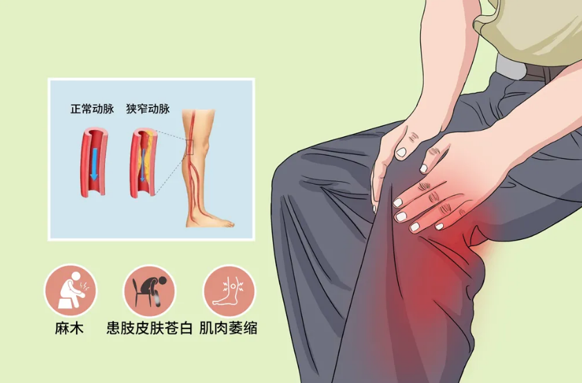 下肢动脉硬化闭塞症有什么症状？