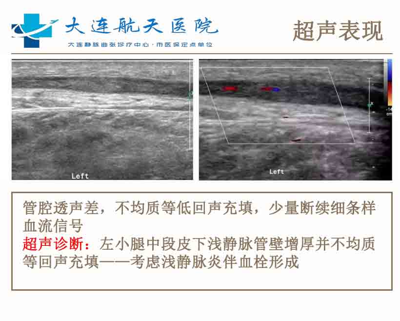 如何治疗静脉炎