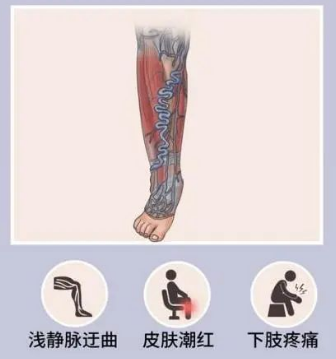从“蚯蚓腿”到“老烂腿”， 静脉曲张要重视！
