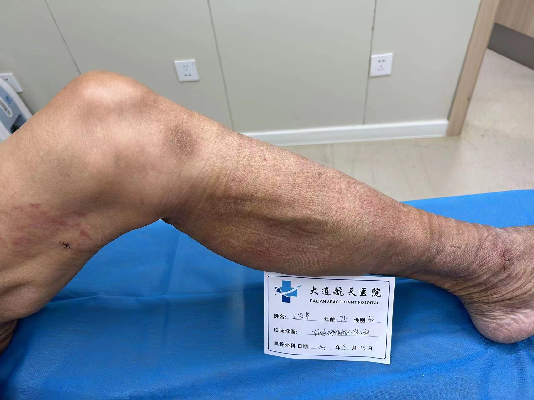 脉管炎的典型症状