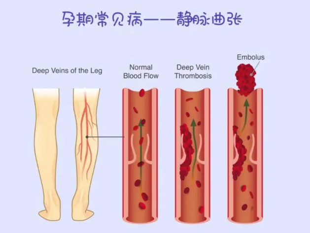 孕期腿上有青筋?小心是静脉曲张！