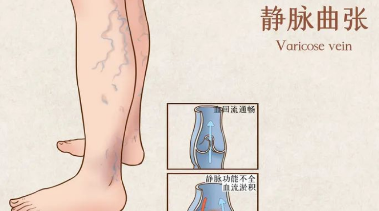 腿上有青筋就是静脉曲张吗？