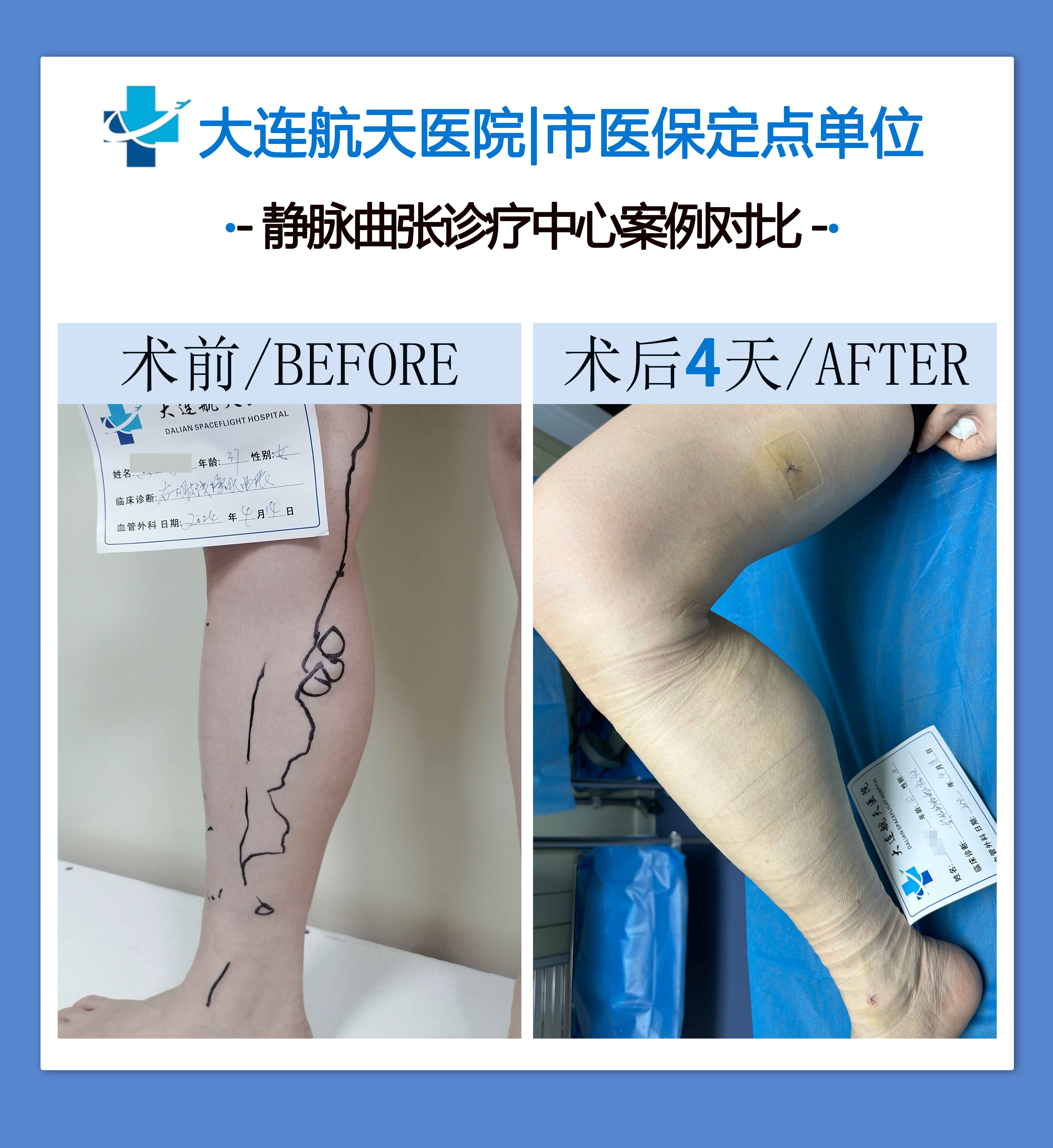 下肢静脉曲张的早期症状表现
