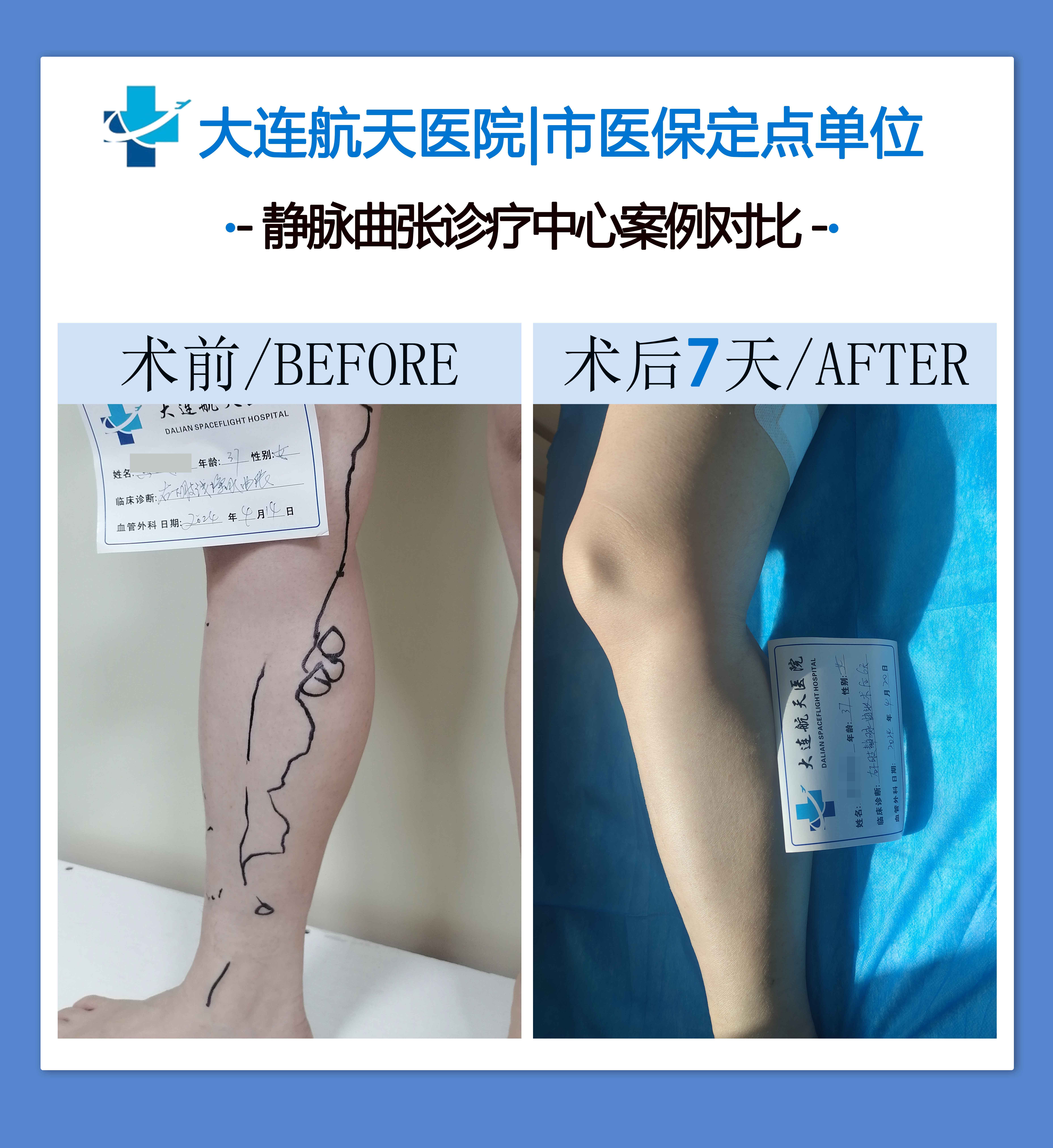 大连航天静脉曲张专科 | 微创治疗优势