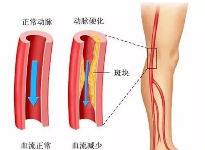 静脉曲张|哪些人容易患下肢动脉硬化闭塞症?