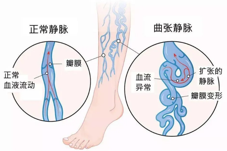 下肢静脉曲张晚期临床表现是什么