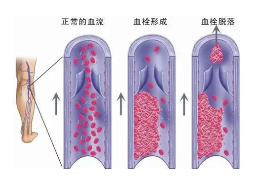 哪些症状提示下肢静脉有血栓了？