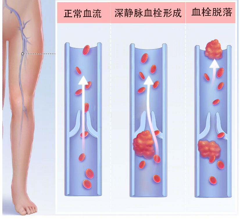 下肢静脉血栓有哪些症状？