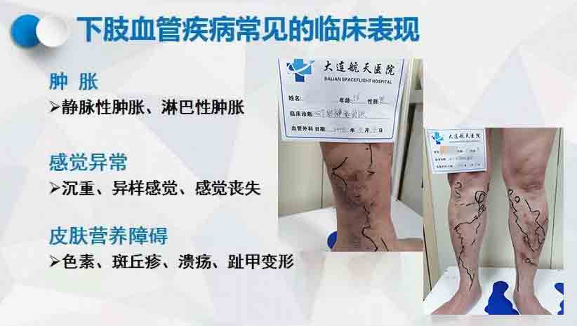 下肢血管"堵塞"怎么办？