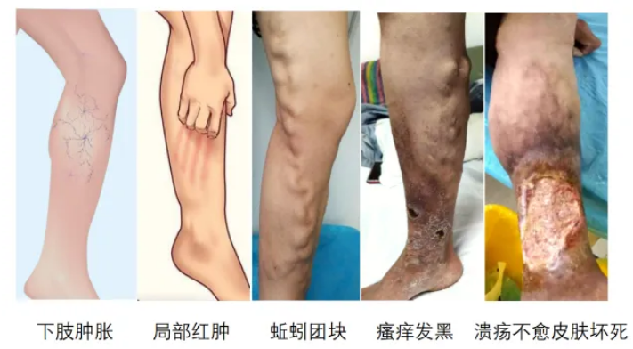 小腿出现静脉曲张怎么办