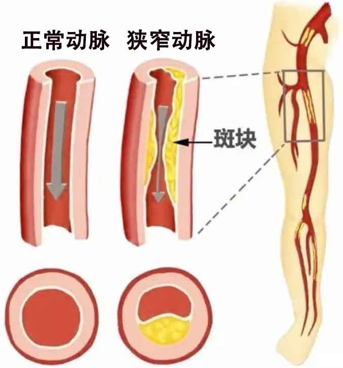 老年人须警惕下肢动脉硬化闭塞症
