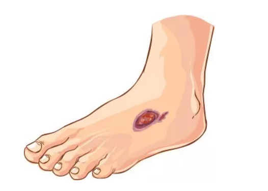 什么原因导致了腿部溃疡？