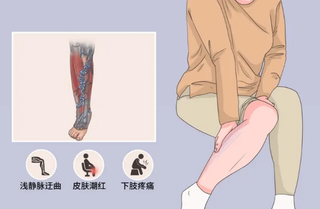 大连静脉曲张专科|微创技术治疗老烂腿
