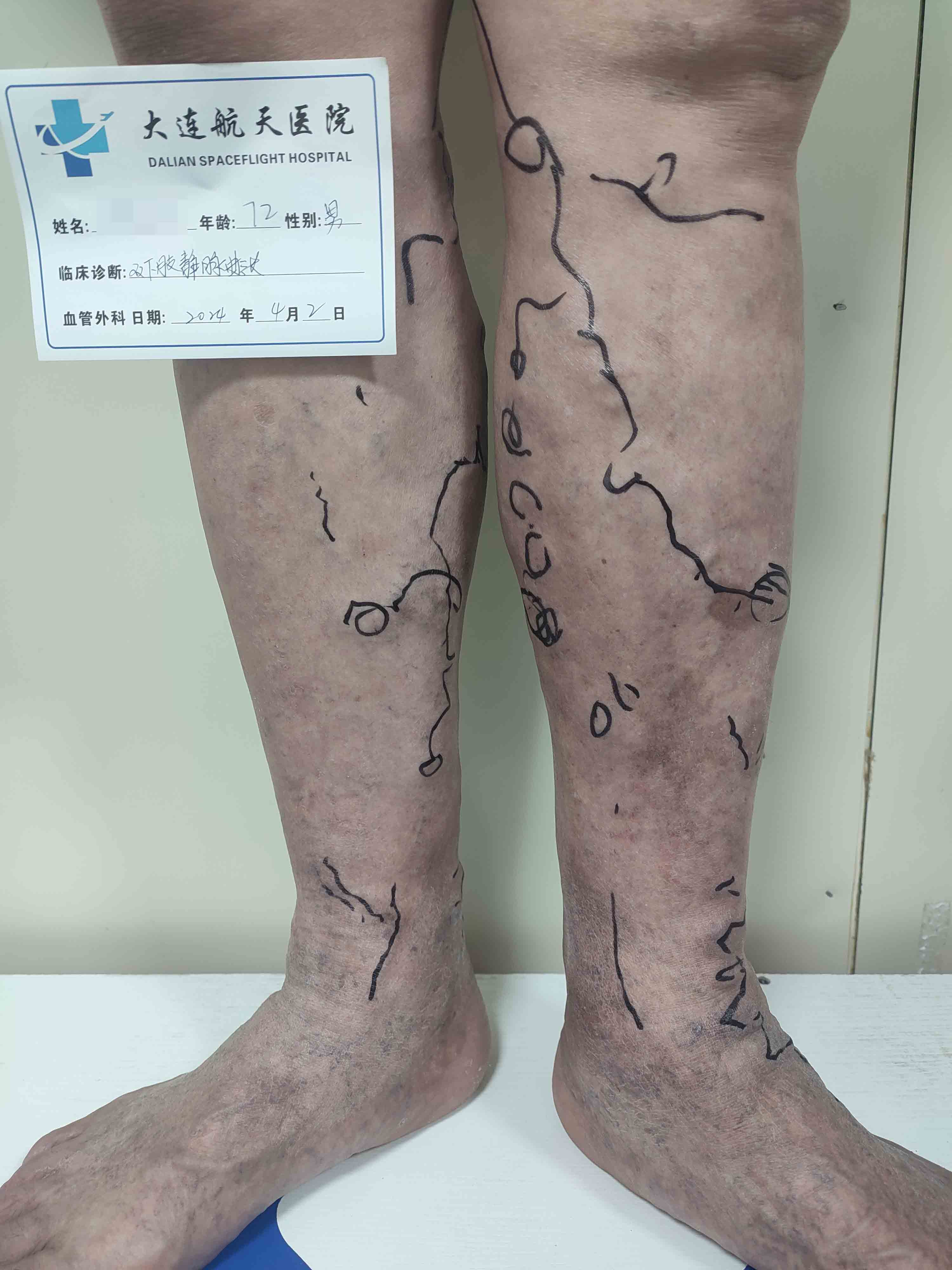 小腿血管鼓起是什么原因？