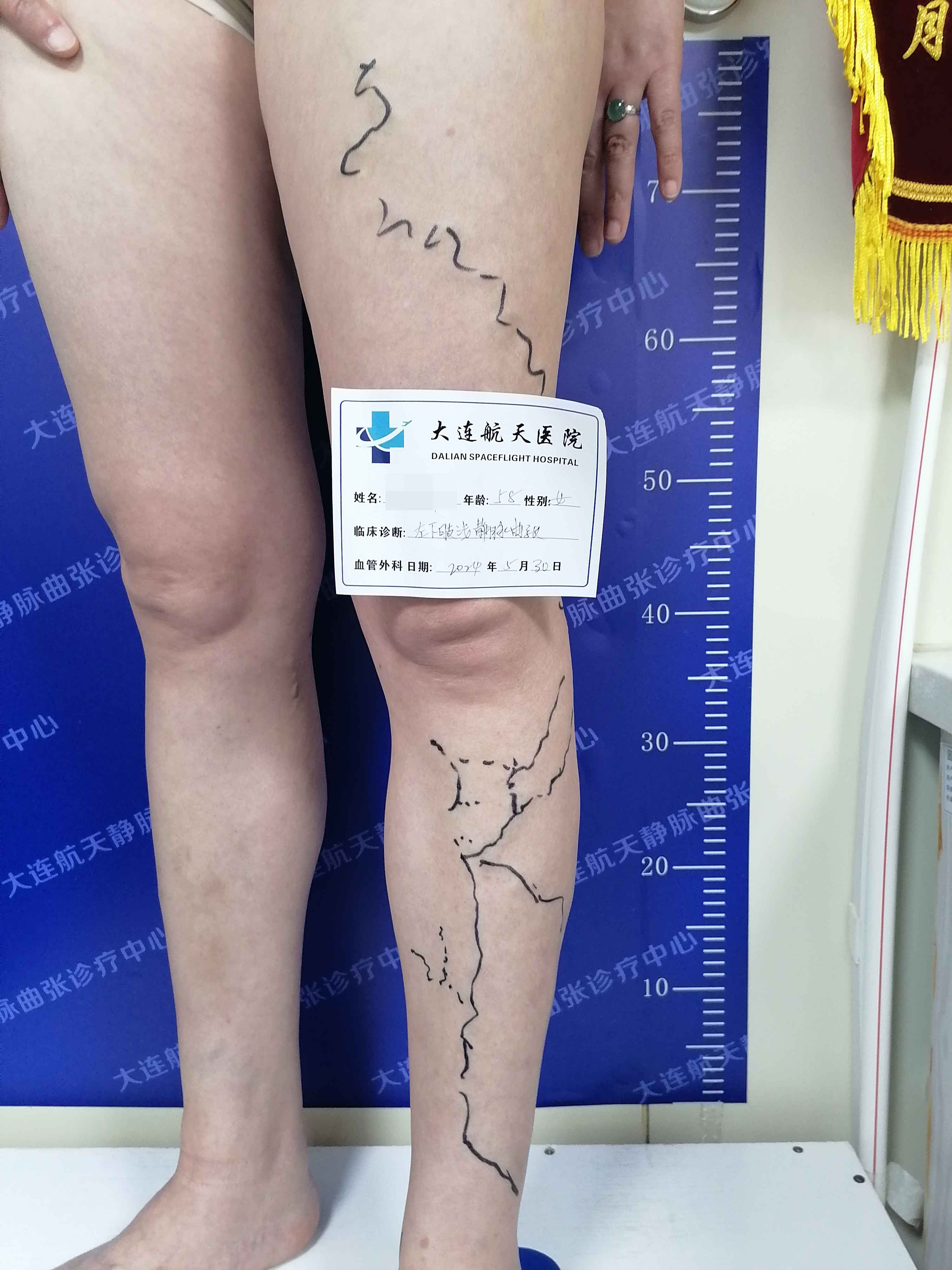 杨超美教授：静脉曲张怎么治疗最好?
