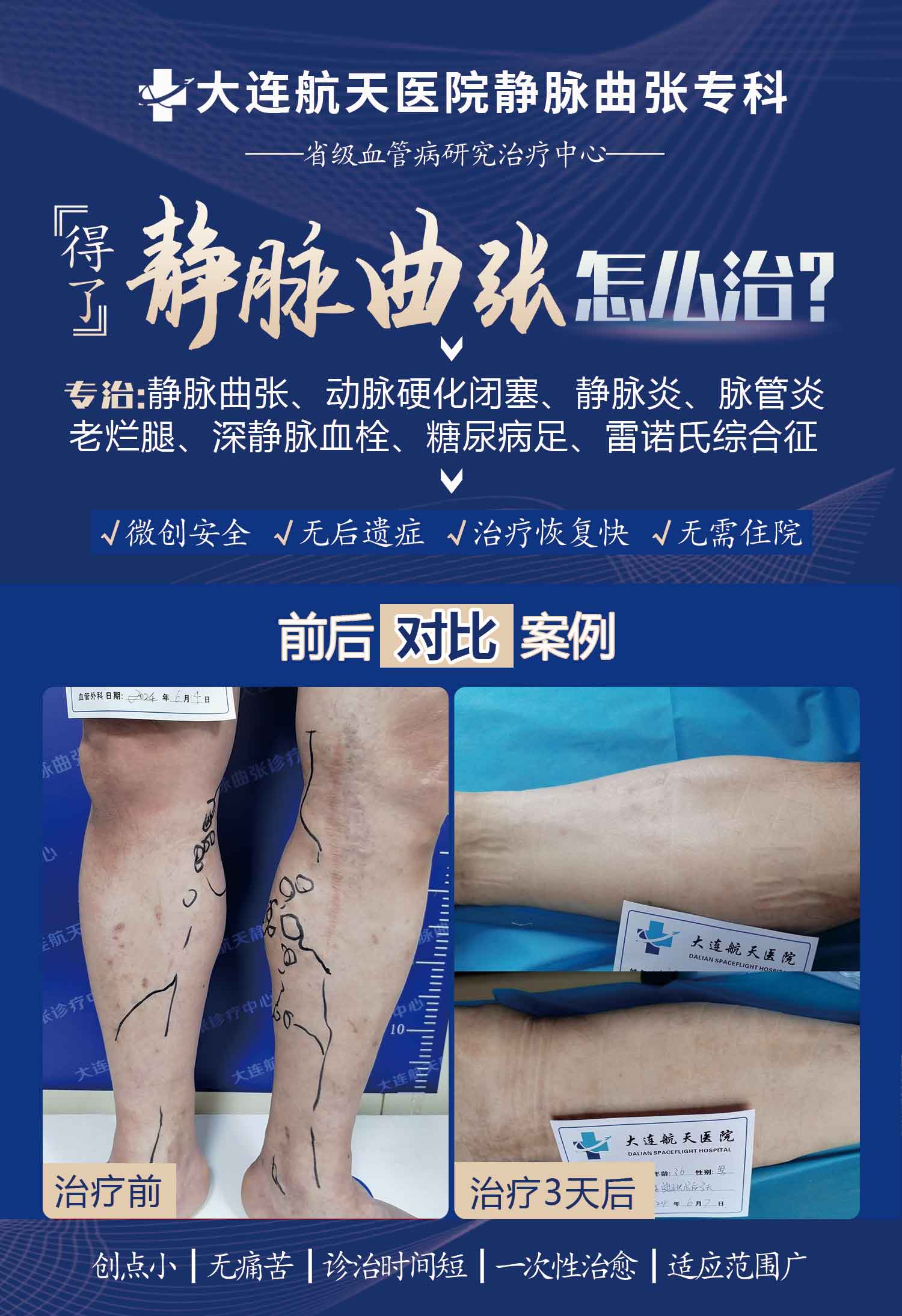 20多年静脉曲张“小蚯蚓”变成了“大蚯蚓”