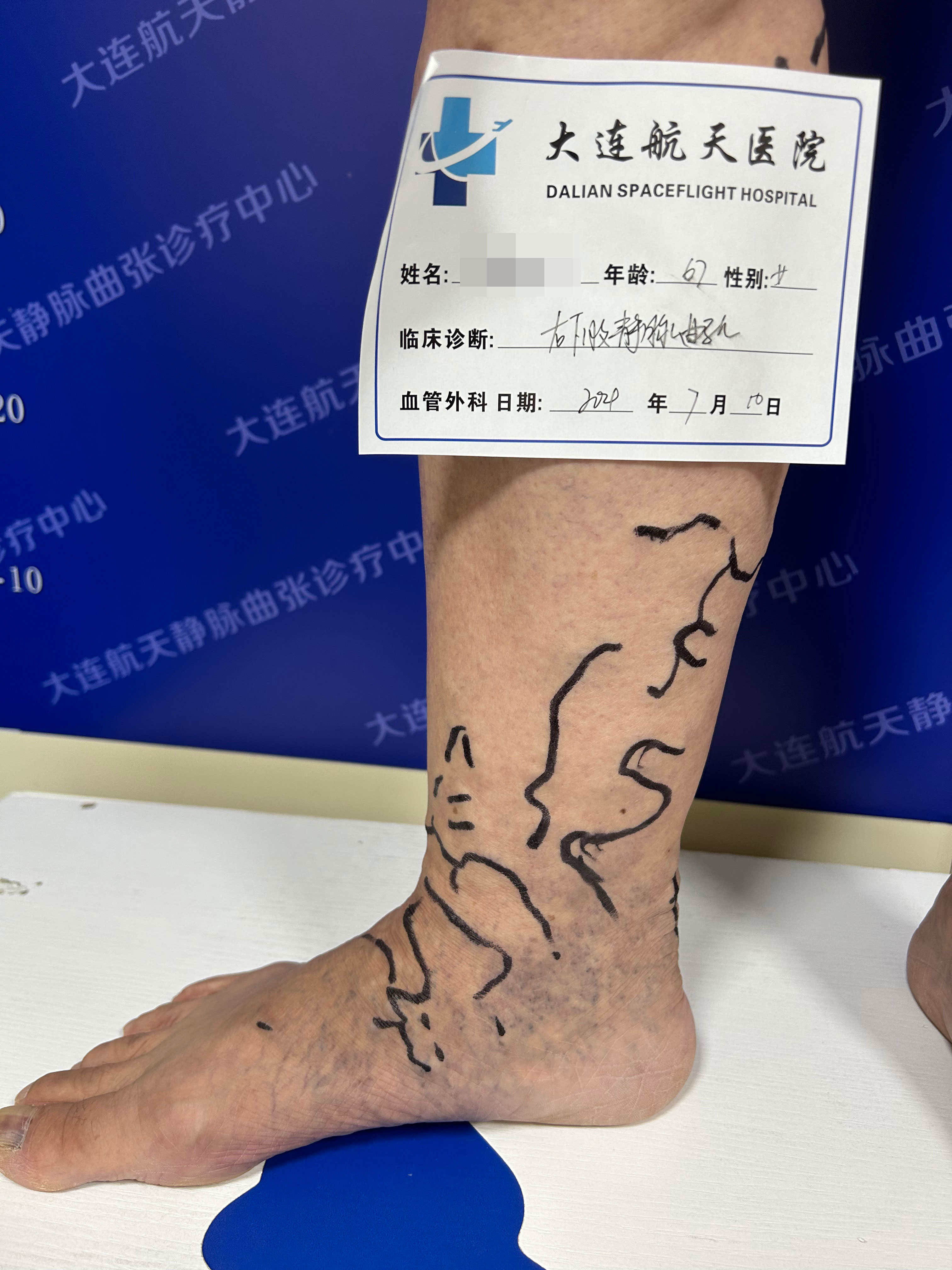 患者 姜女士 67岁 右下肢静脉曲张