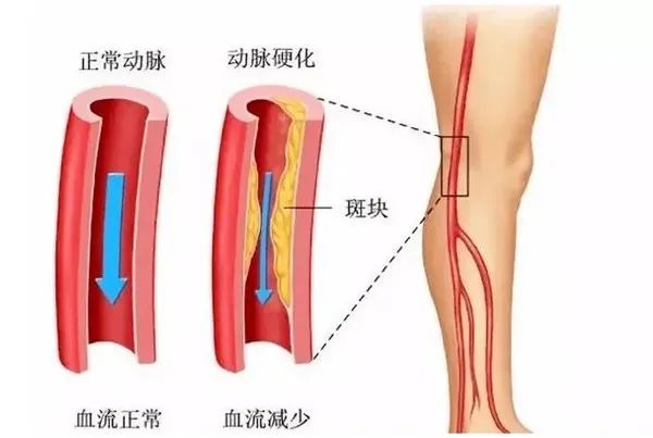 下肢动脉硬化闭塞症的症状与表现