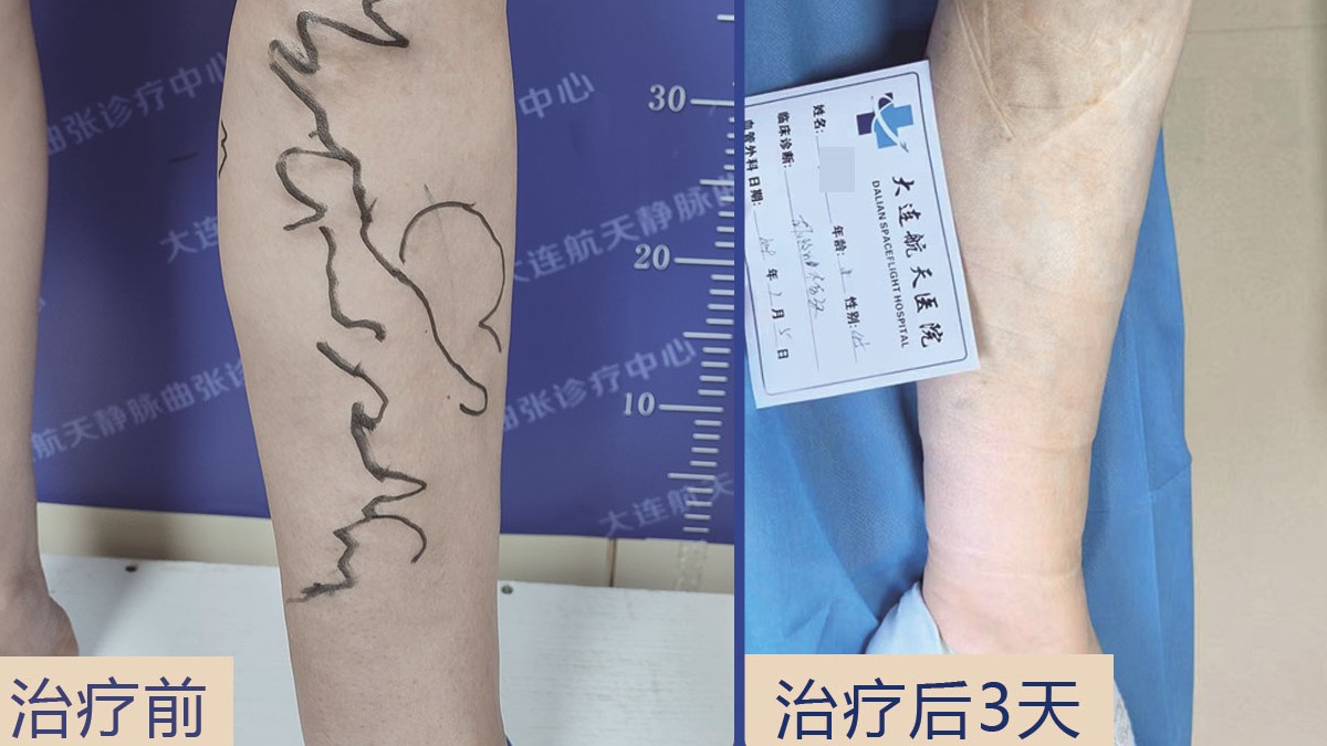 静脉曲张资深专家【王宝珠】坐诊航天