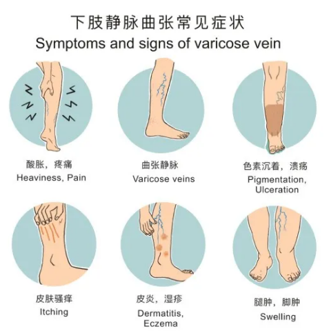 下肢静脉曲张比较严重发黑