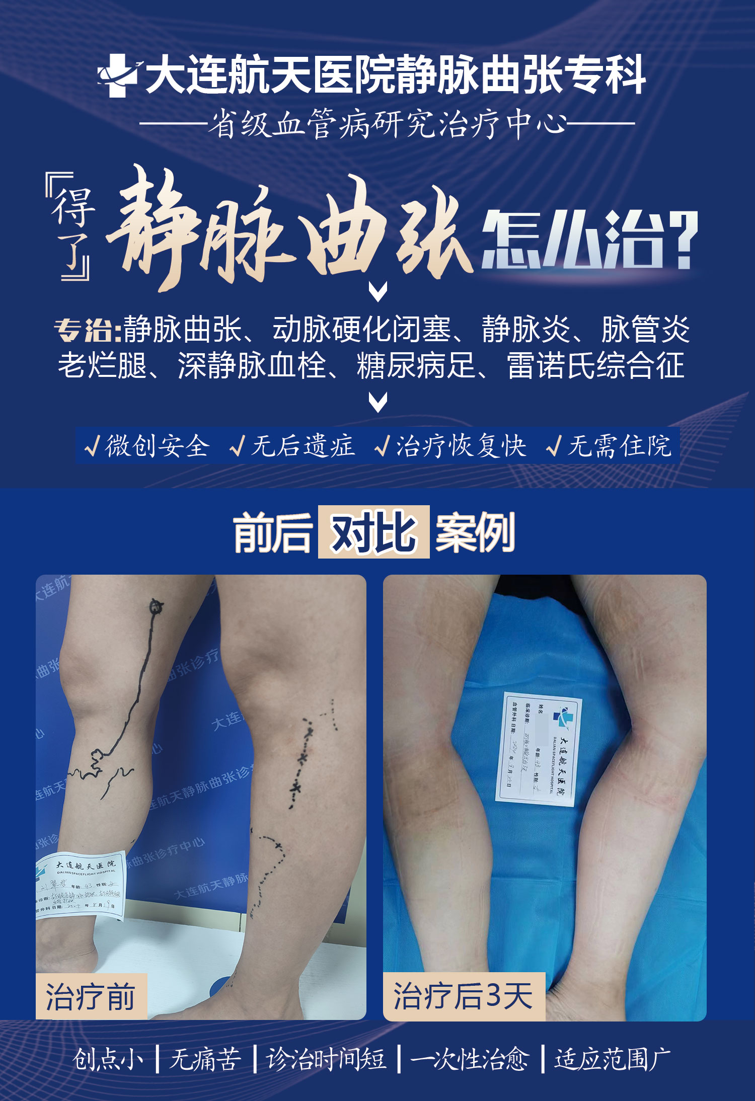 特聘专家王宝珠谈:"下肢静脉曲张"微创手术