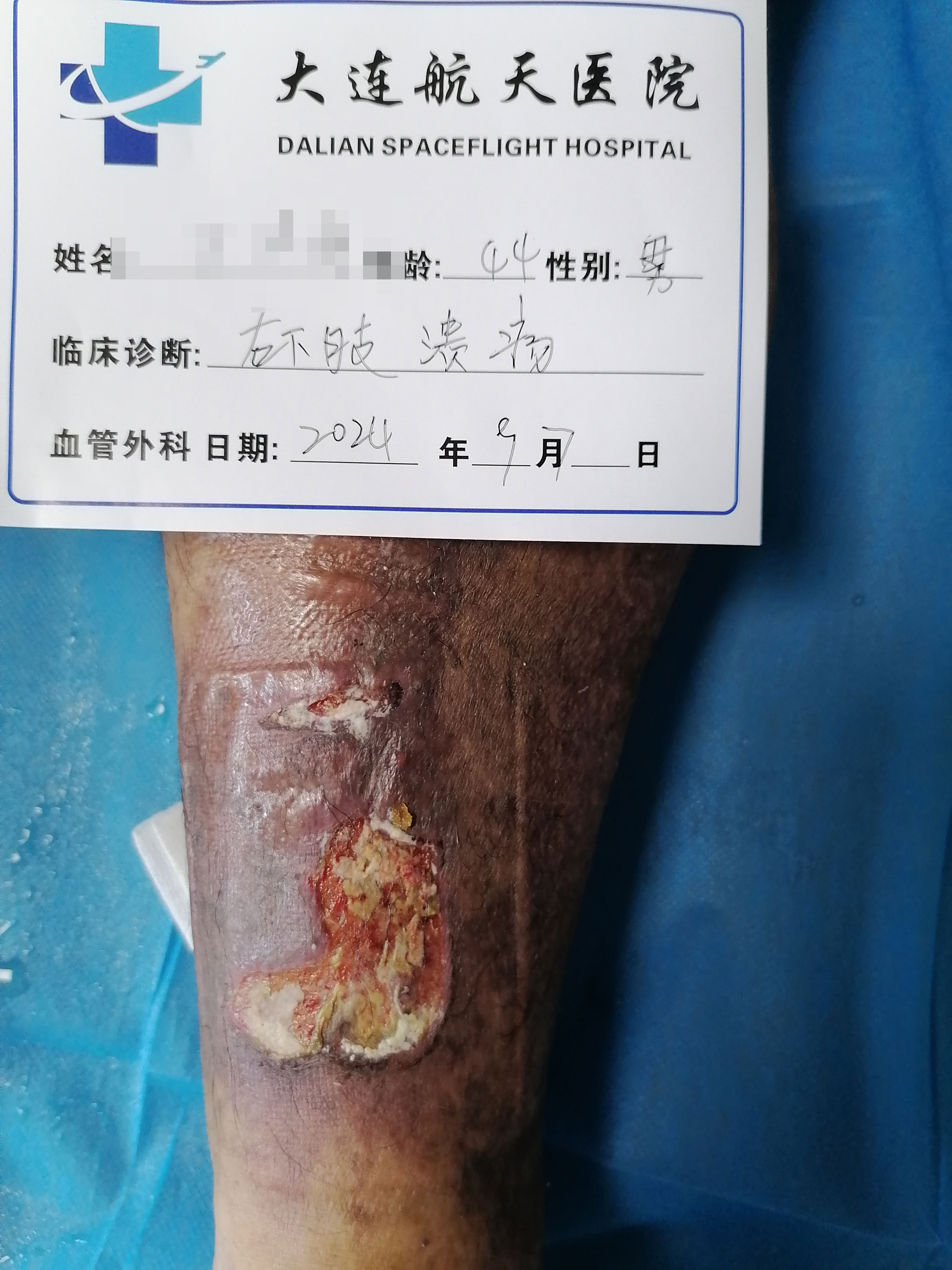 下肢静脉溃疡的成因及临床表现