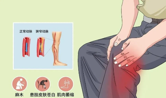 大连航天医院|老年人腿发凉下肢动脉硬化闭塞症