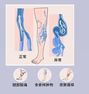 大连静脉曲张治疗||大连航天医院治疗静脉曲张好吗？