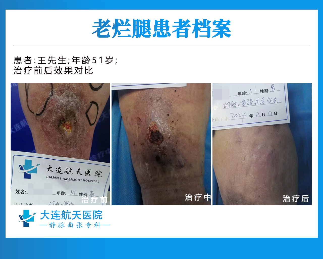 大连哪里看老烂腿比较好