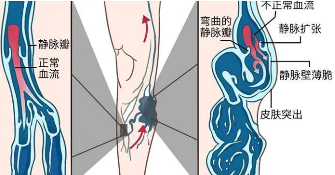 静脉曲张该怎么治？