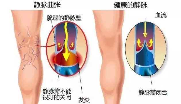 患有静脉曲张怎么办