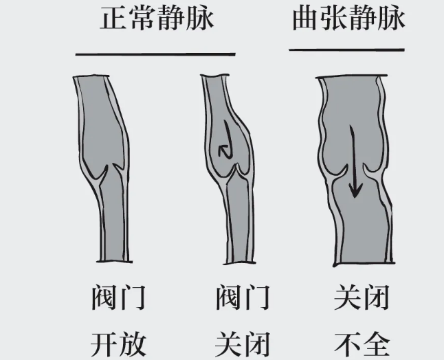 腿部毛细血管扩张是静脉曲张吗