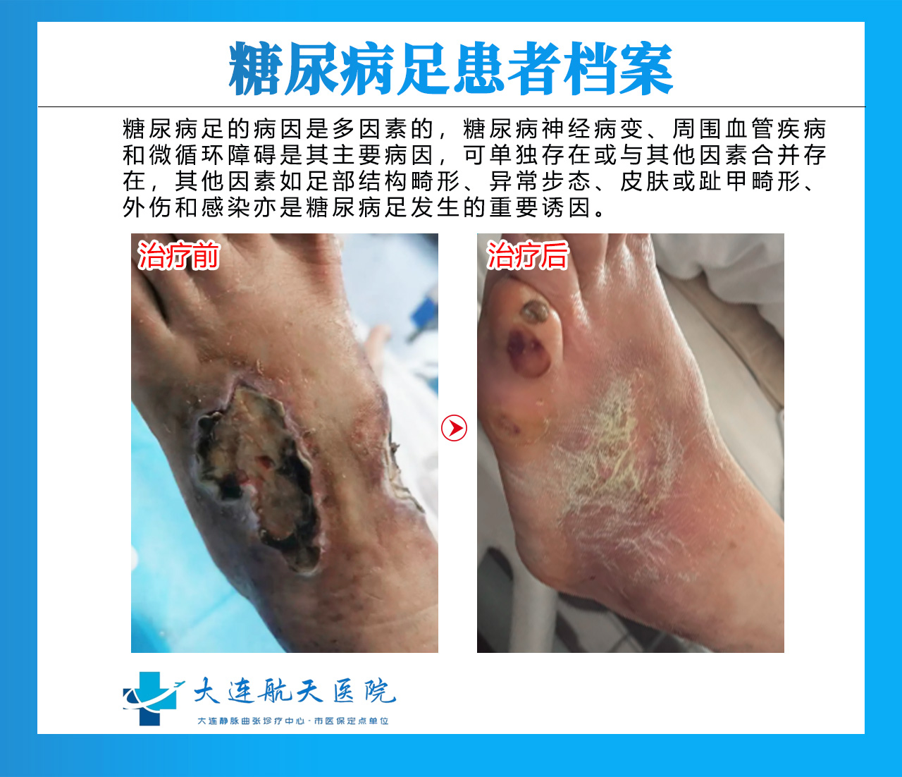 糖尿病足图片初期症状有哪些？