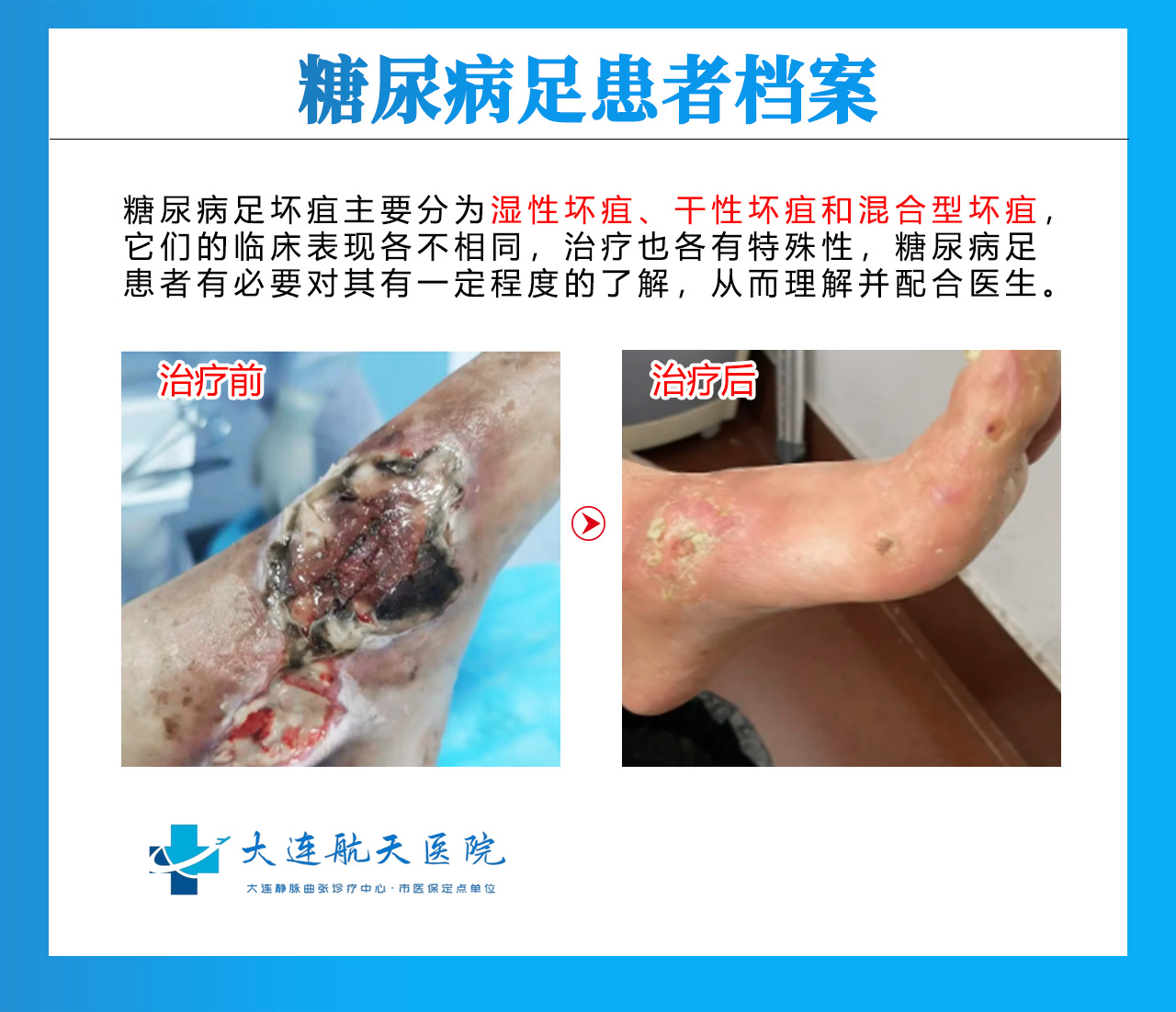 糖尿病足只是治脚？治标不治本